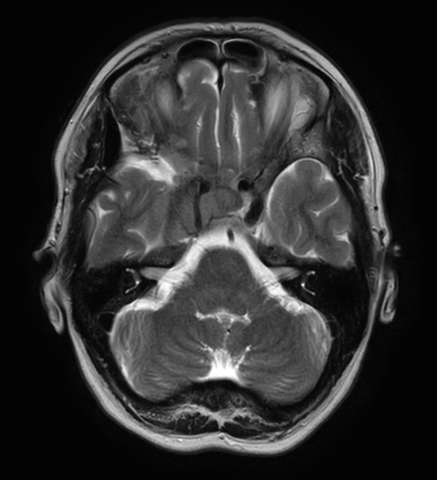 Axial T2w TSE post contrast