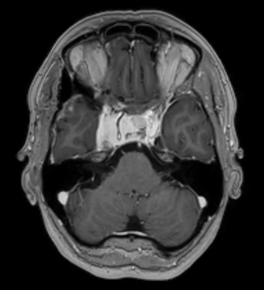 Axial 3D T1w TFE post contrast