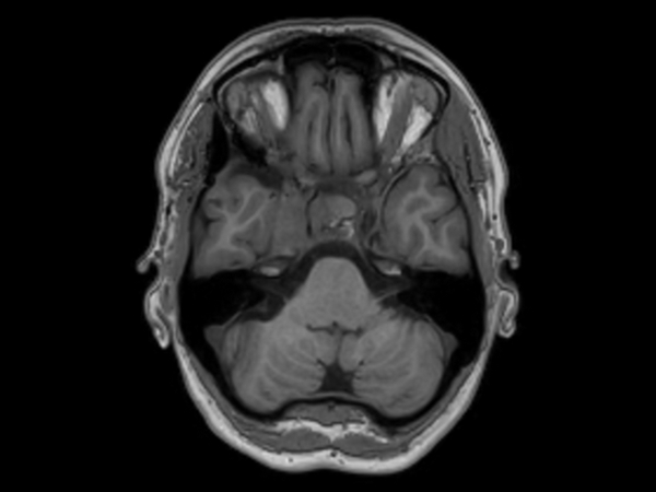 Axial 3D T1w TFE pre contrast