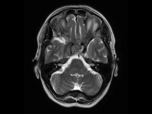 Axial T2w TSE post contrast