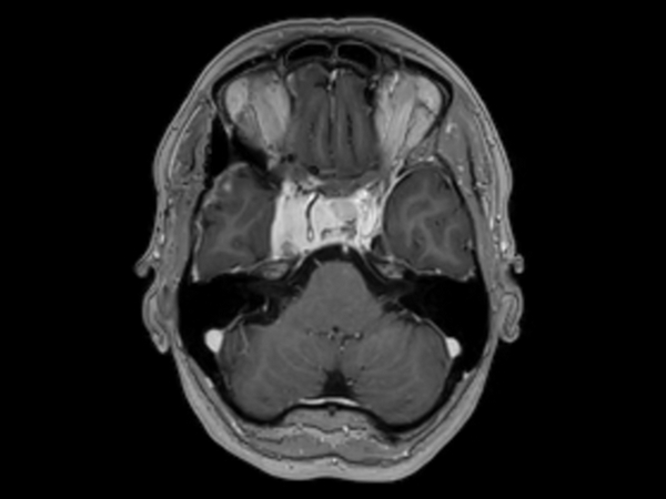 Axial 3D T1w TFE post contrast