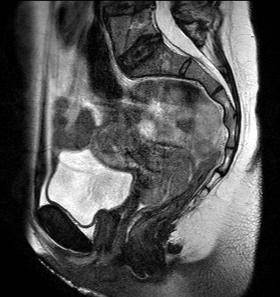 MRI simulation for cervix treatment variable bladder filling state