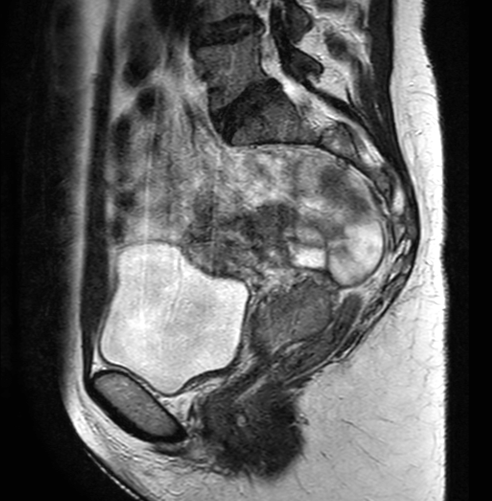 mri-simulation-for-cervix-treatment-variable-bladder-filling-state