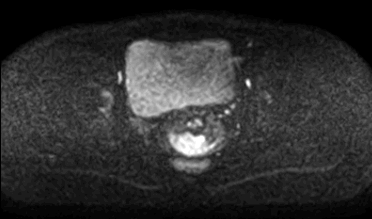 Axial DWI SPAIR (b800) mid