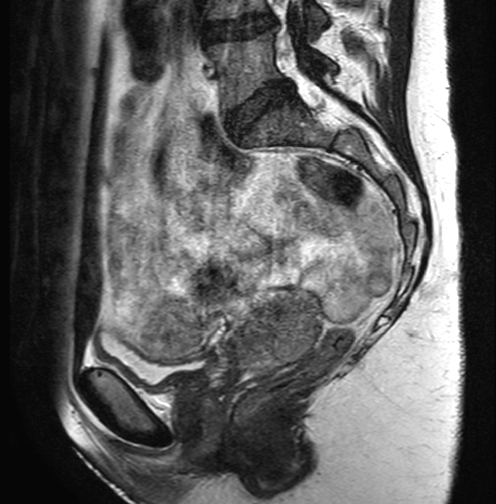 Sagital T2w TSE empty bladder