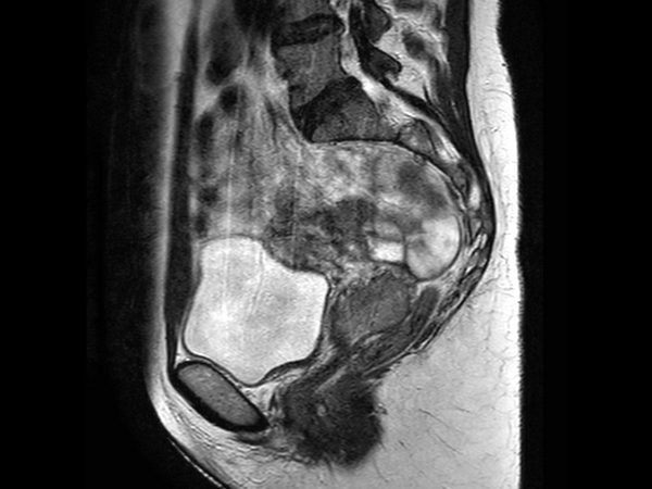 Sagital T2w TSE full bladder