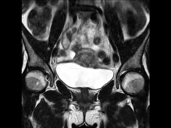 Coronal T2w TSE mid