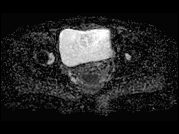 Axial DWI (ADC) mid