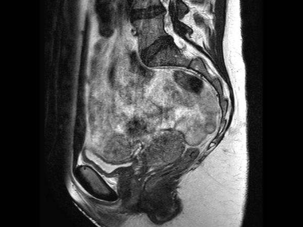 Sagital T2w TSE empty bladder