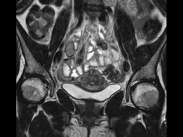 Coronal T2w TSE mid