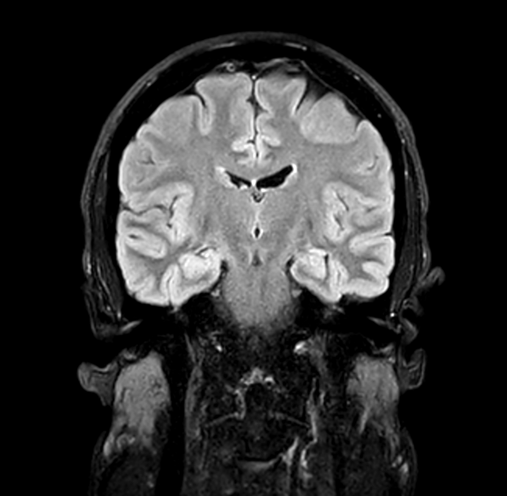 Coronal 3D BrainVIEW FLAIR