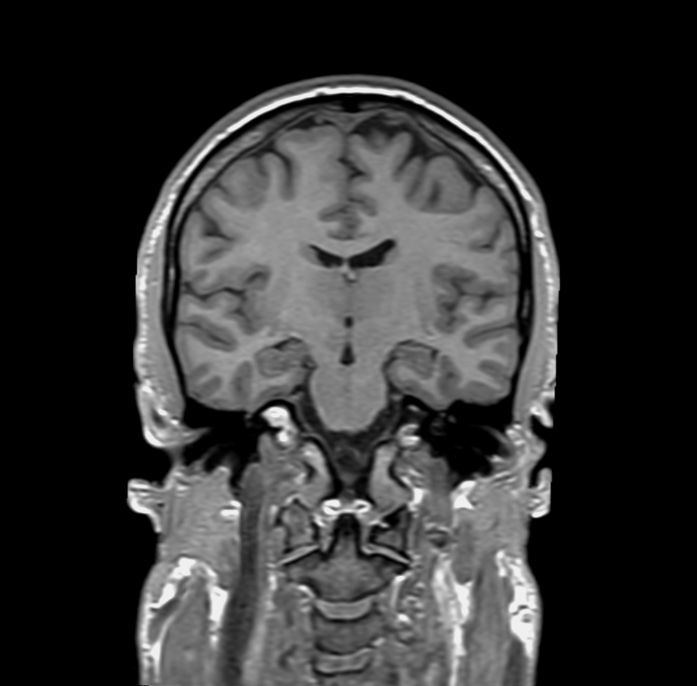 T1w 3D FFE (coronal reformat)