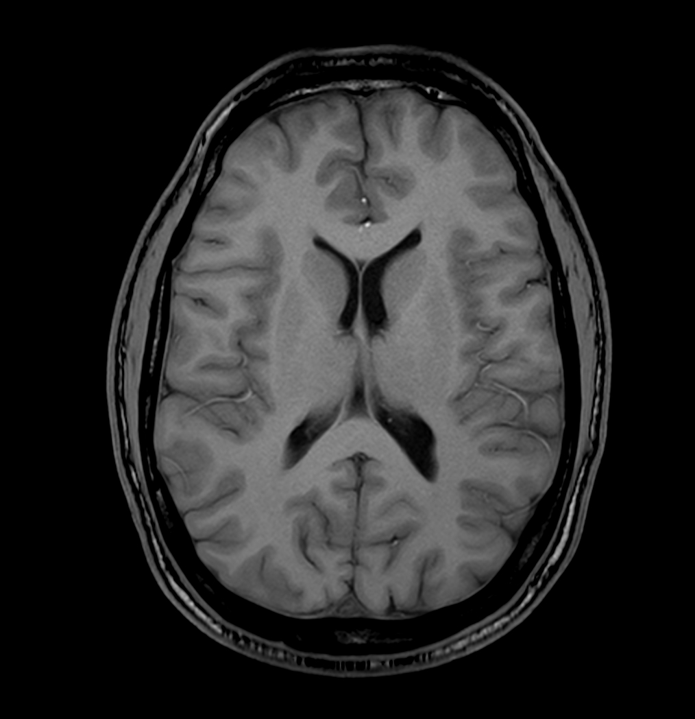 T1w 3D FFE (axial reformat)