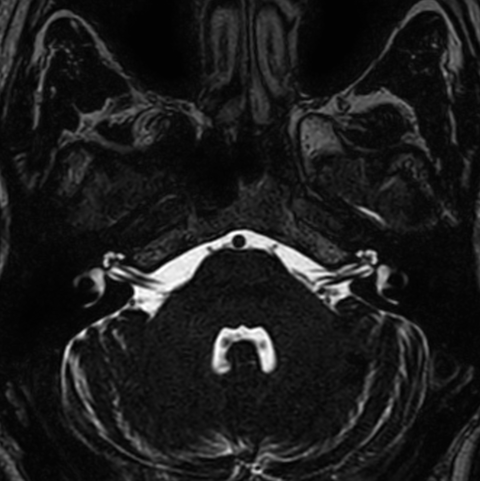 Axial T2w 3D DRIVE (IAC)