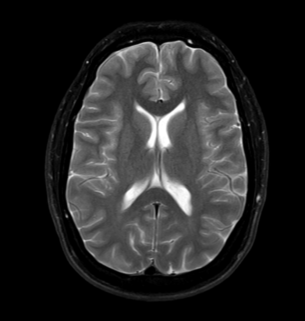 Axial T2w mDIXON XD - T2w TSE (Water only)