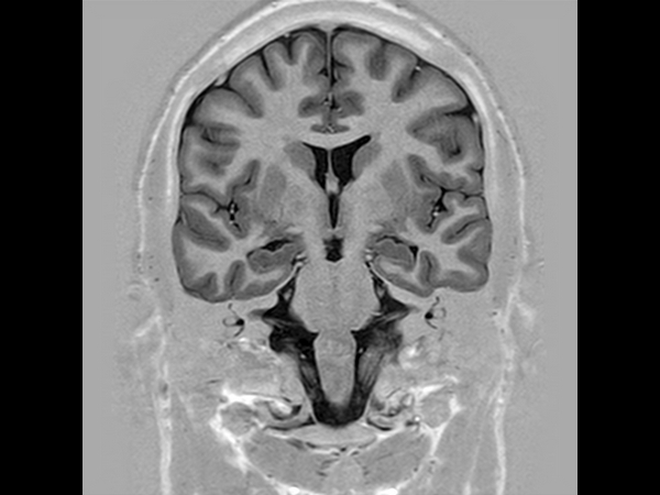 Coronal T1w IR