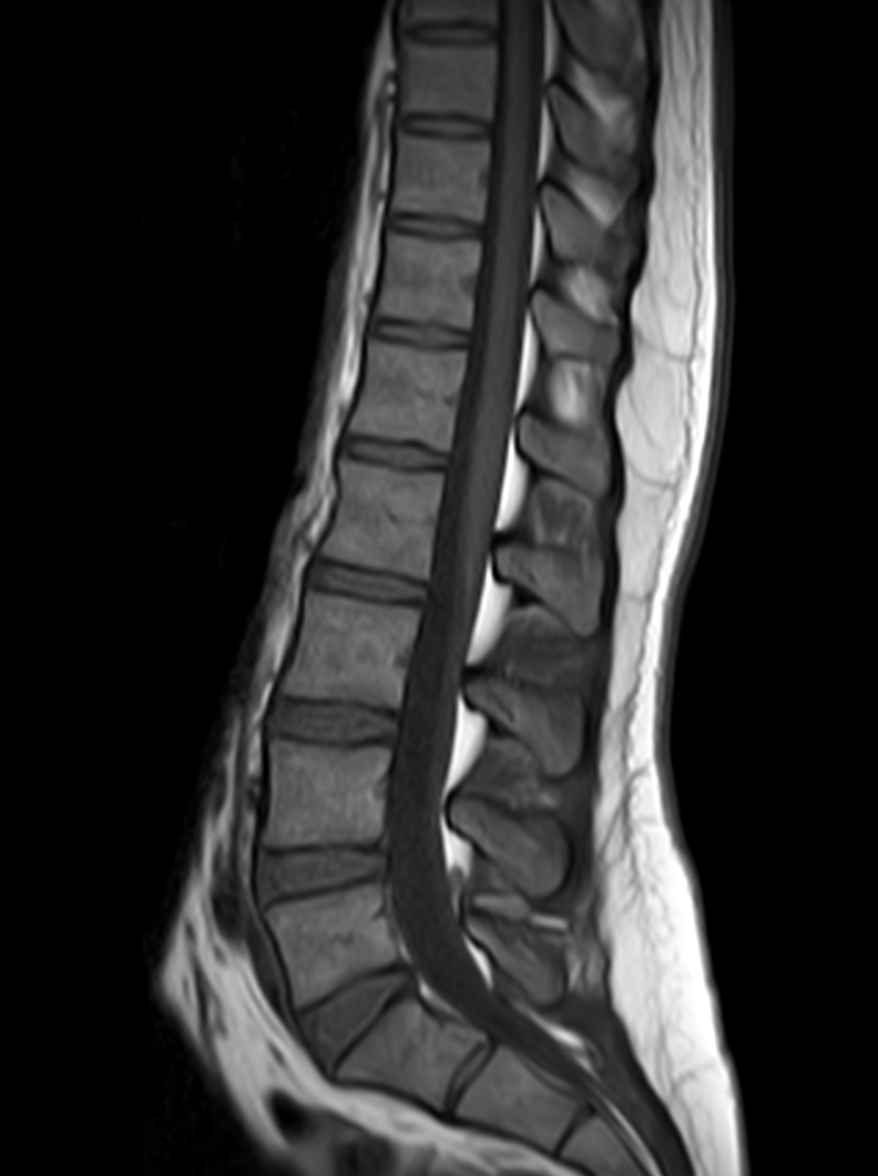 Sagittal mDIXON XD -  T1w TSE (In Phase)