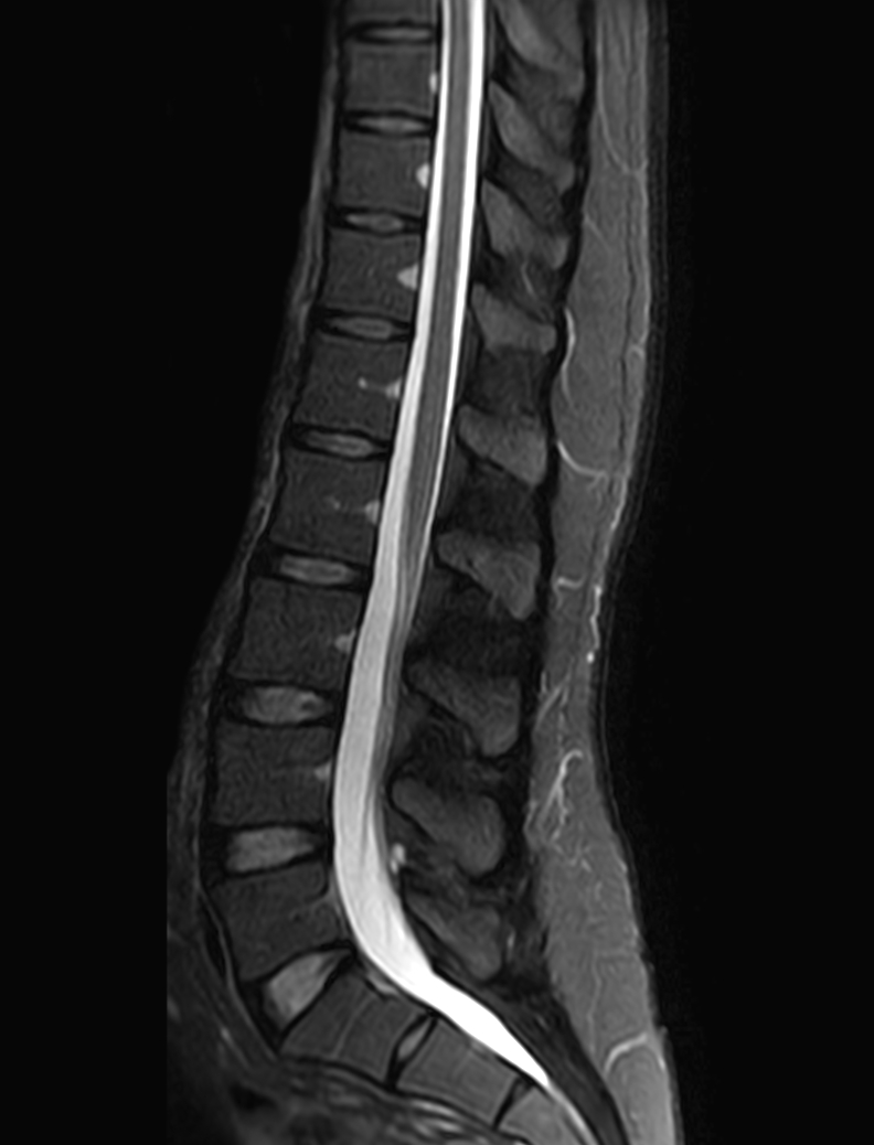 Sagittal mDIXON XD - T2w TSE (partial FatSat)