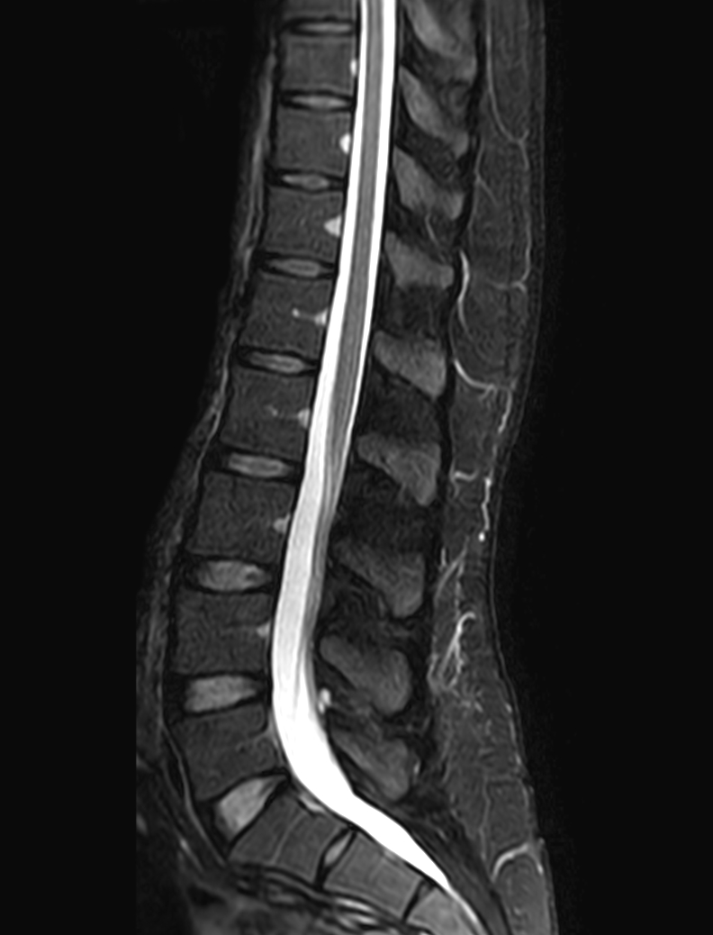 Sagittal mDIXON XD - T2w TSE (Water only)