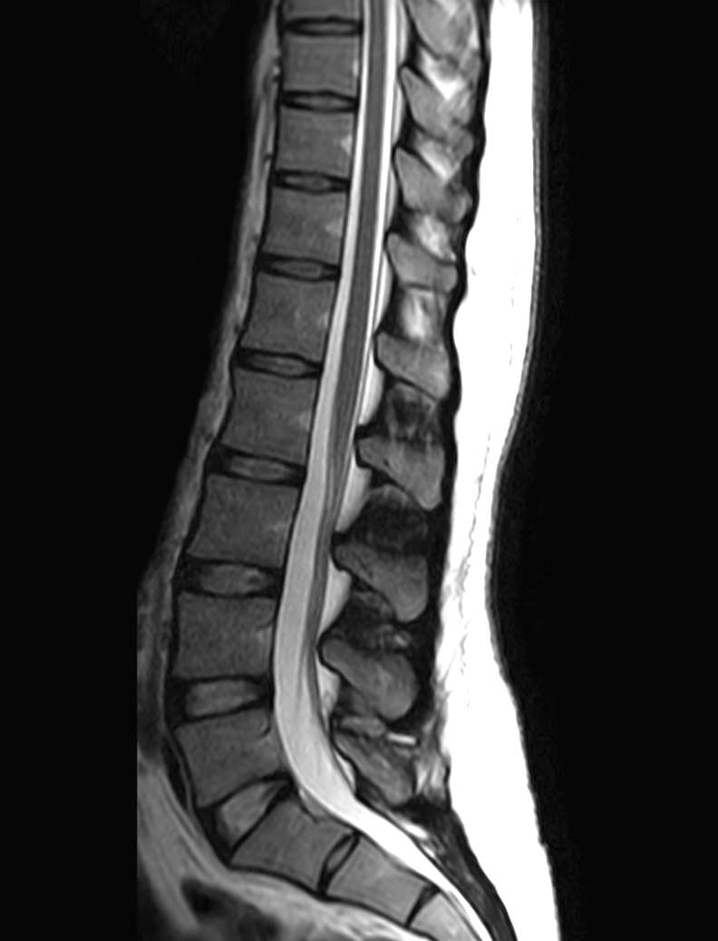 Sagittal mDIXON XD - T2w TSE (In Phase)
