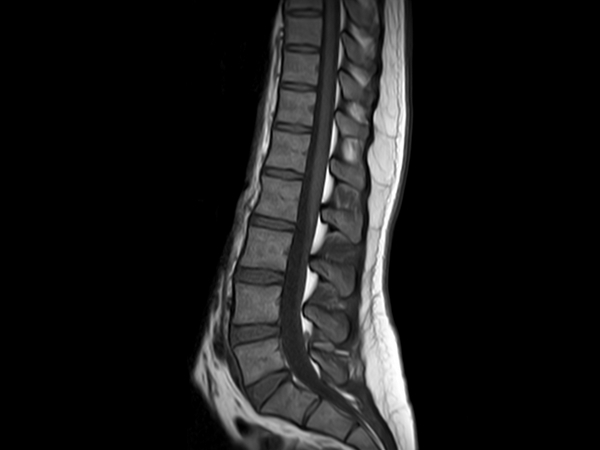 Sagittal mDIXON XD -  T1w TSE (In Phase)