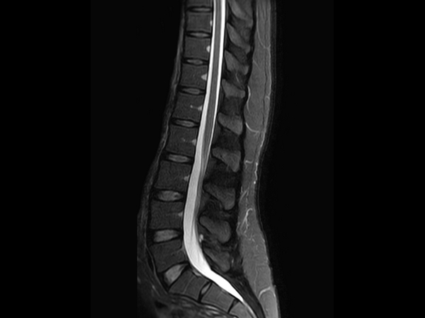 Sagittal mDIXON XD - T2w TSE (partial FatSat)