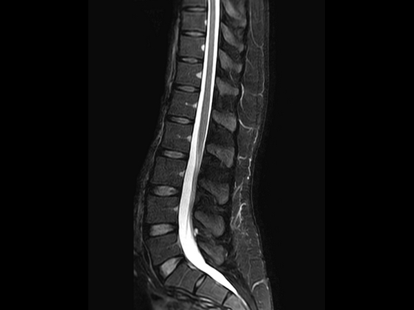 Sagittal mDIXON XD - T2w TSE (Water only)