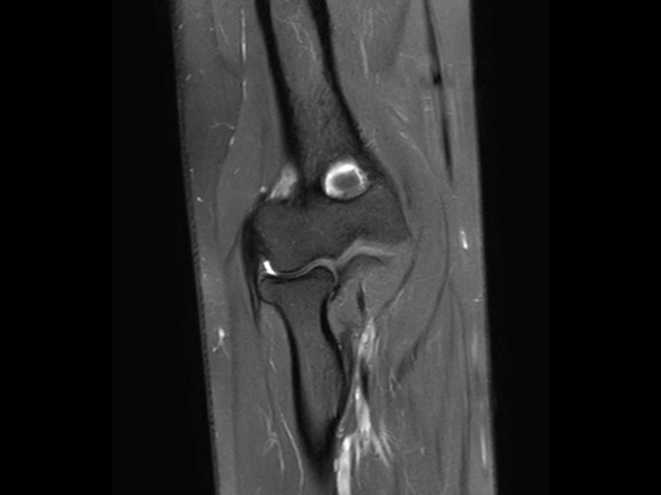 Coronal PDw SPAIR