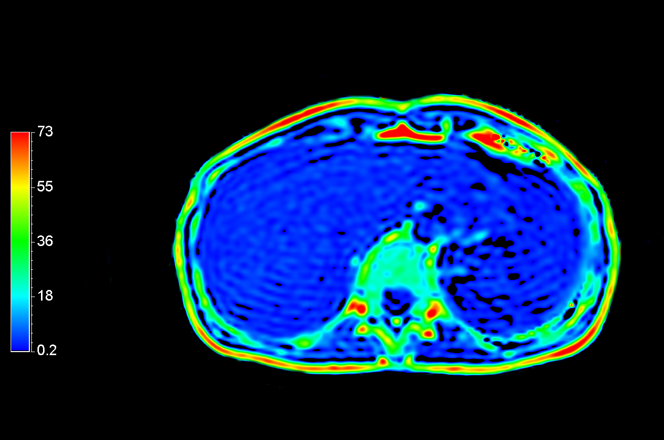 Axial mDIXON Quant (Fat fraction)