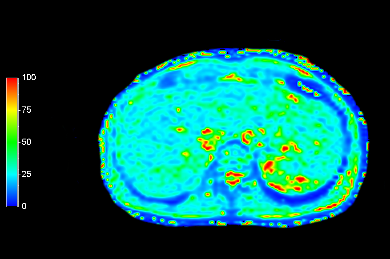 Axial mDIXON Quant (T2*)