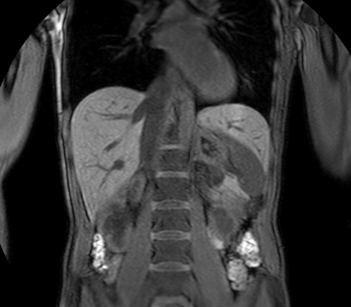 Coronal mDIXON XD - T1w FFE plus gado (Water only)