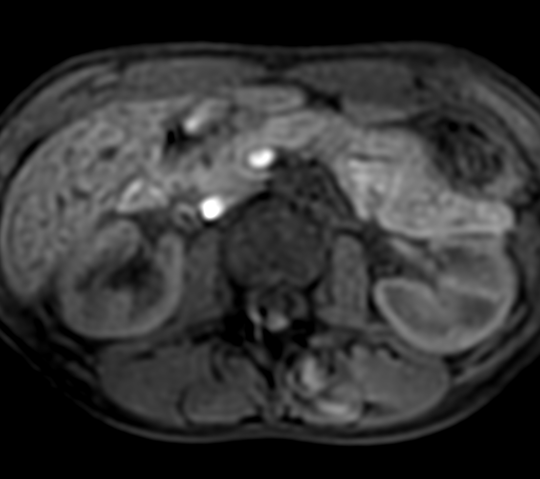 Axial T1w eTHRIVE (pancreas)