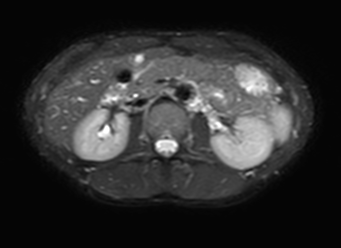 Axial T2w SSh (pancreas)
