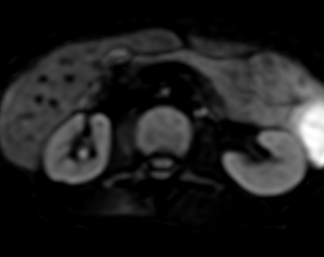Axial DWI (b600) (pancreas)
