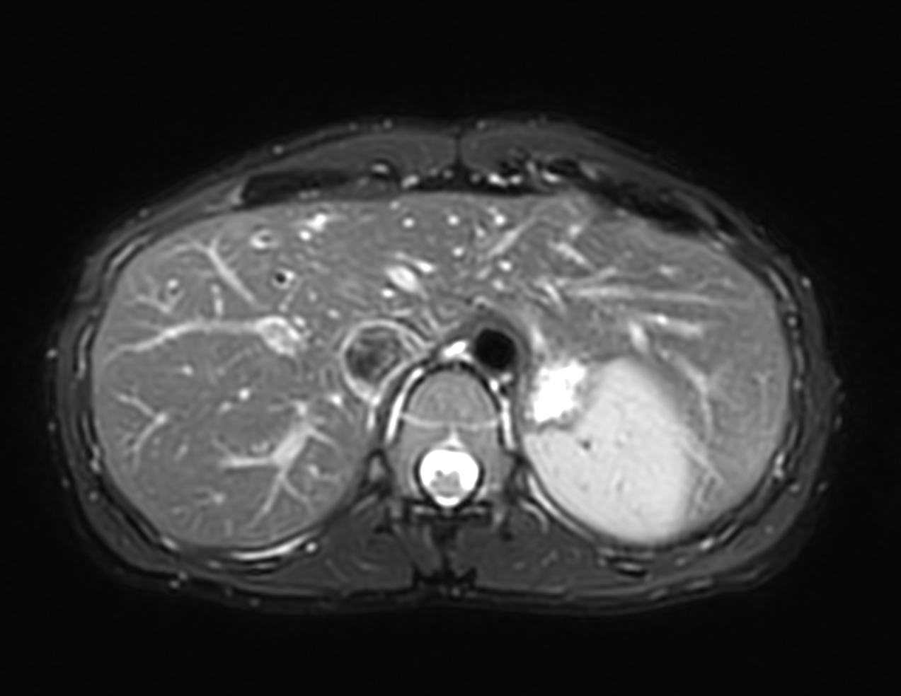 Axial MultiVane XD - T2w SPIR