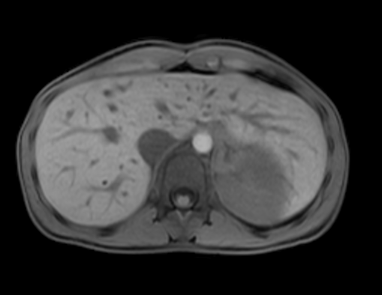 Axial mDIXON XD - T1w FFE (Water only)