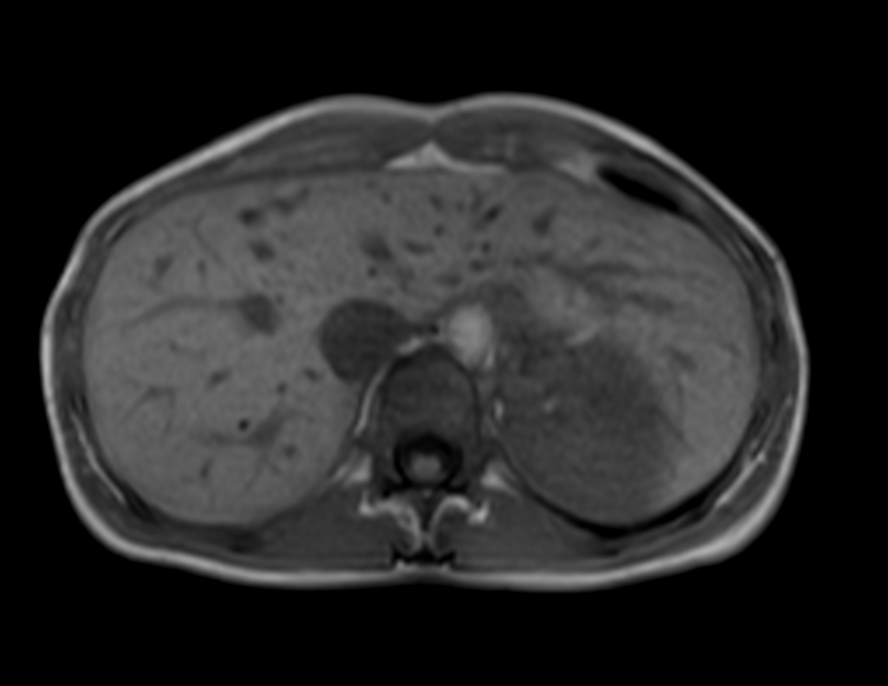 Axial mDIXON XD - T1w FFE (In Phase)