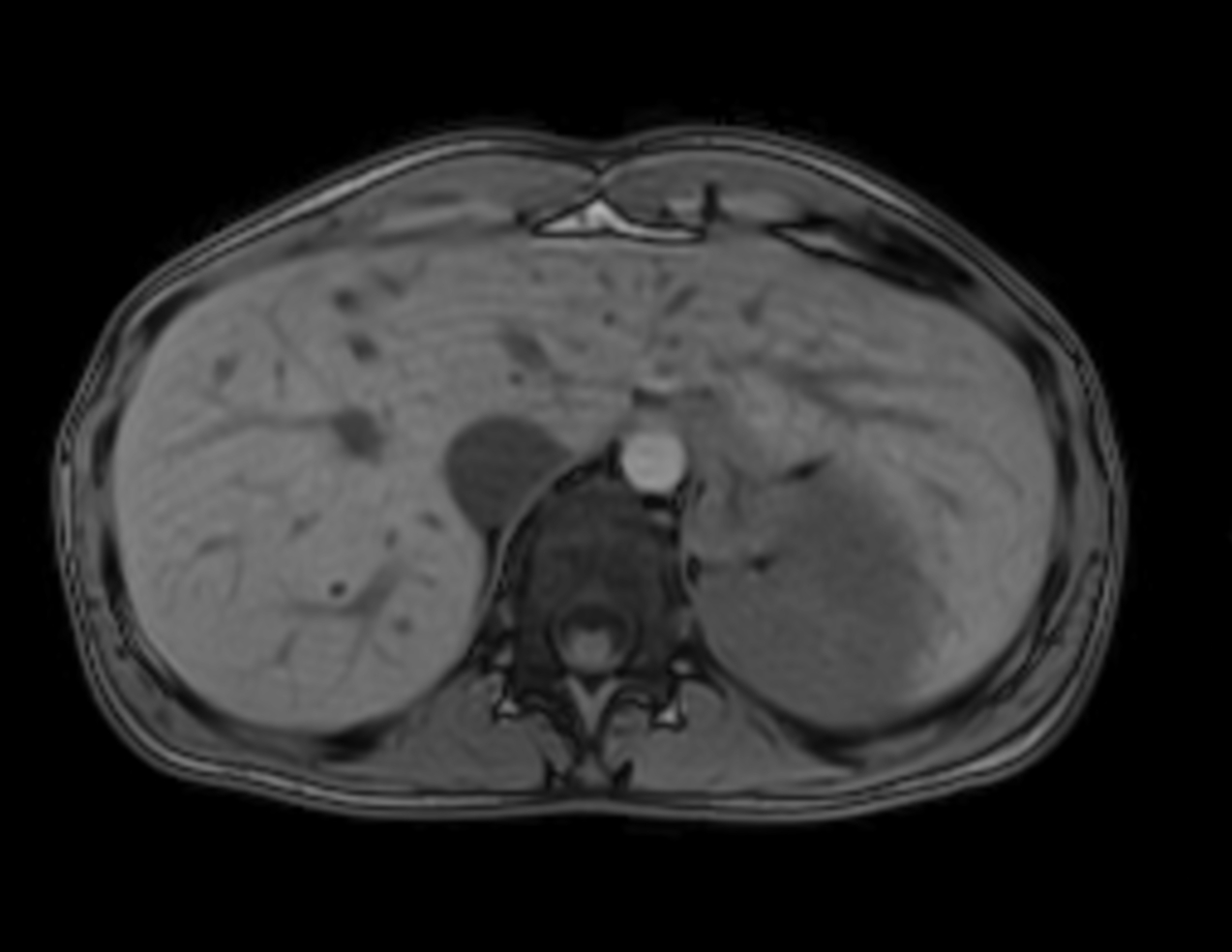 Axial mDIXON XD - T1w FFE (Out Phase)