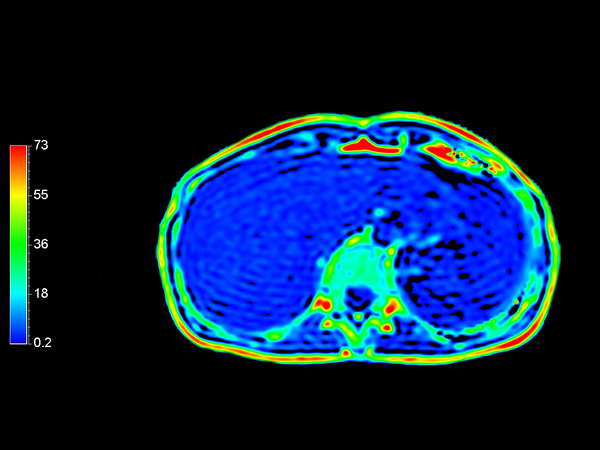 Axial mDIXON Quant (Fat fraction)