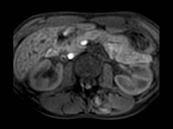 Axial T1w eTHRIVE (pancreas)