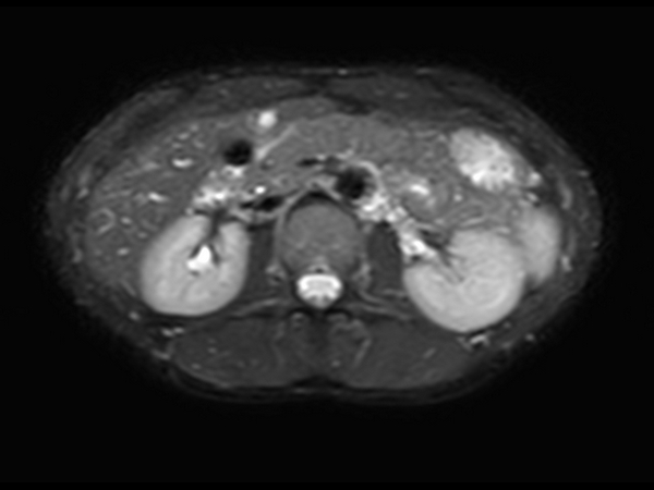 Axial T2w SSh (pancreas)