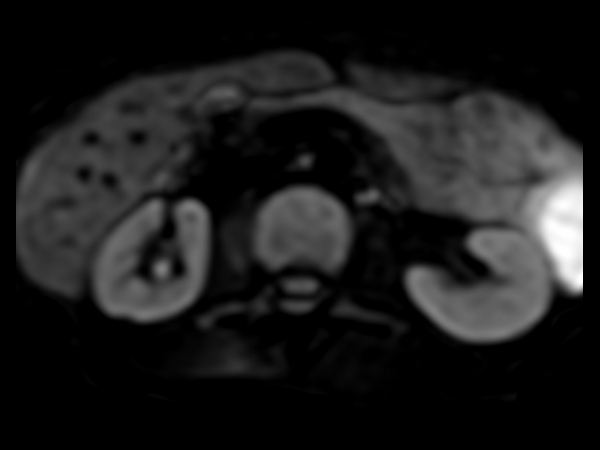 Axial DWI (b600) (pancreas)