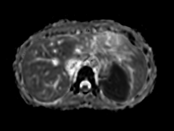 Axial DWI (ADC)