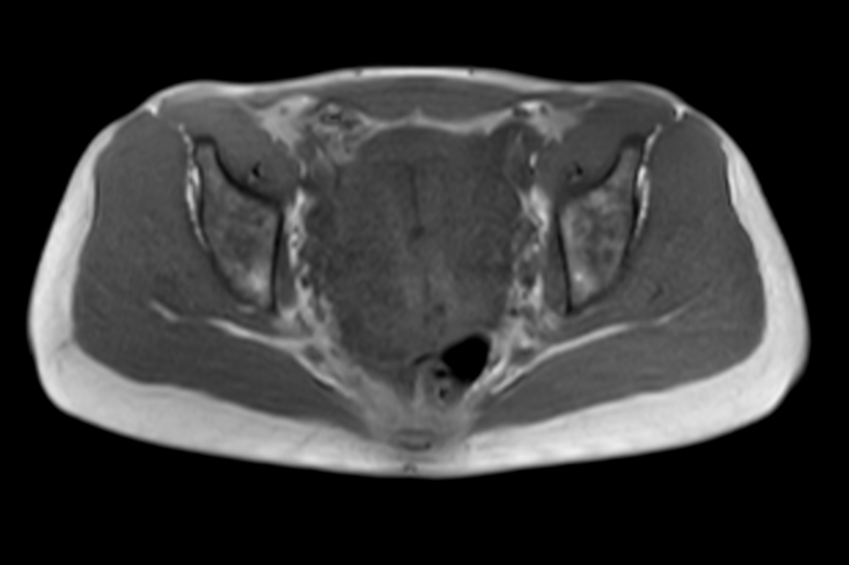 Axial mDIXON XD - T1w FFE (In Phase)