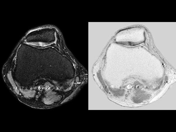 Axial Dual IR sequence