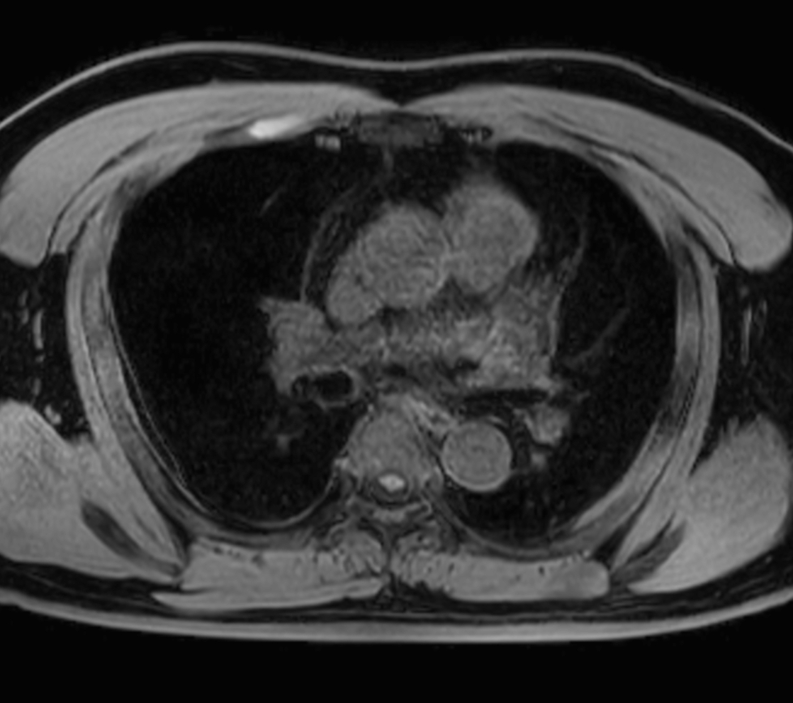 Axial mDIXON XD - T1w FFE (Water only)