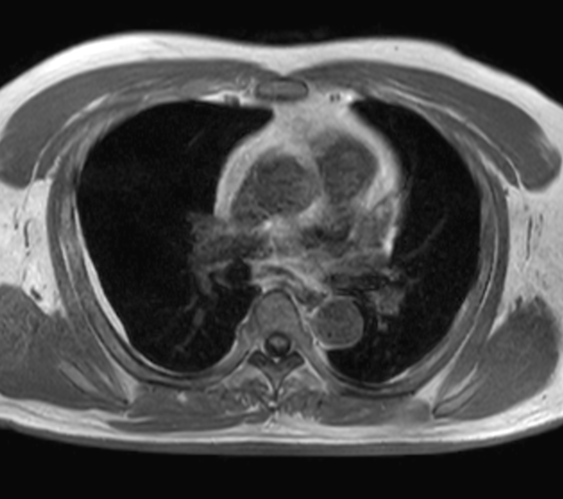 Axial mDIXON XD - T1w FFE (In Phase)
