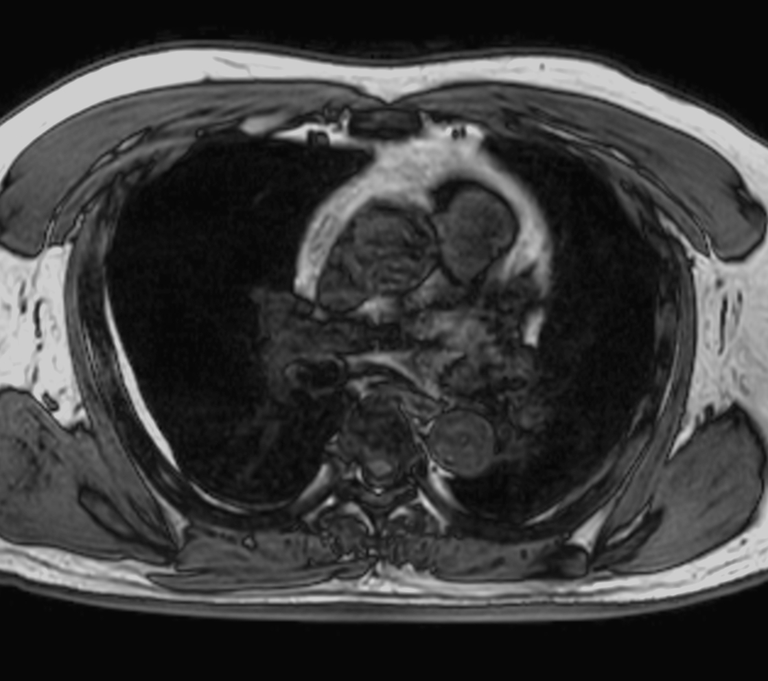 Axial mDIXON XD - T1w FFE (Out Phase)