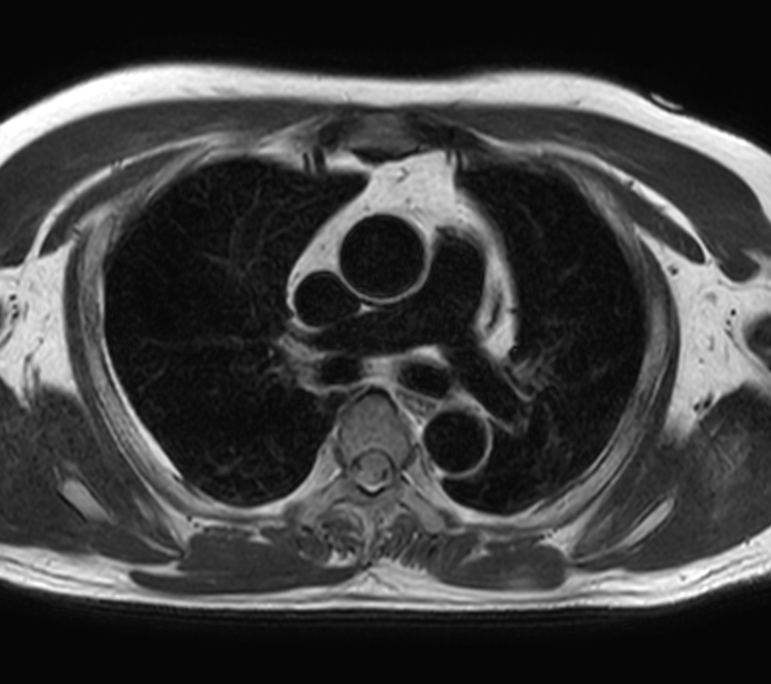 Axial T2w TSE - Black Blood