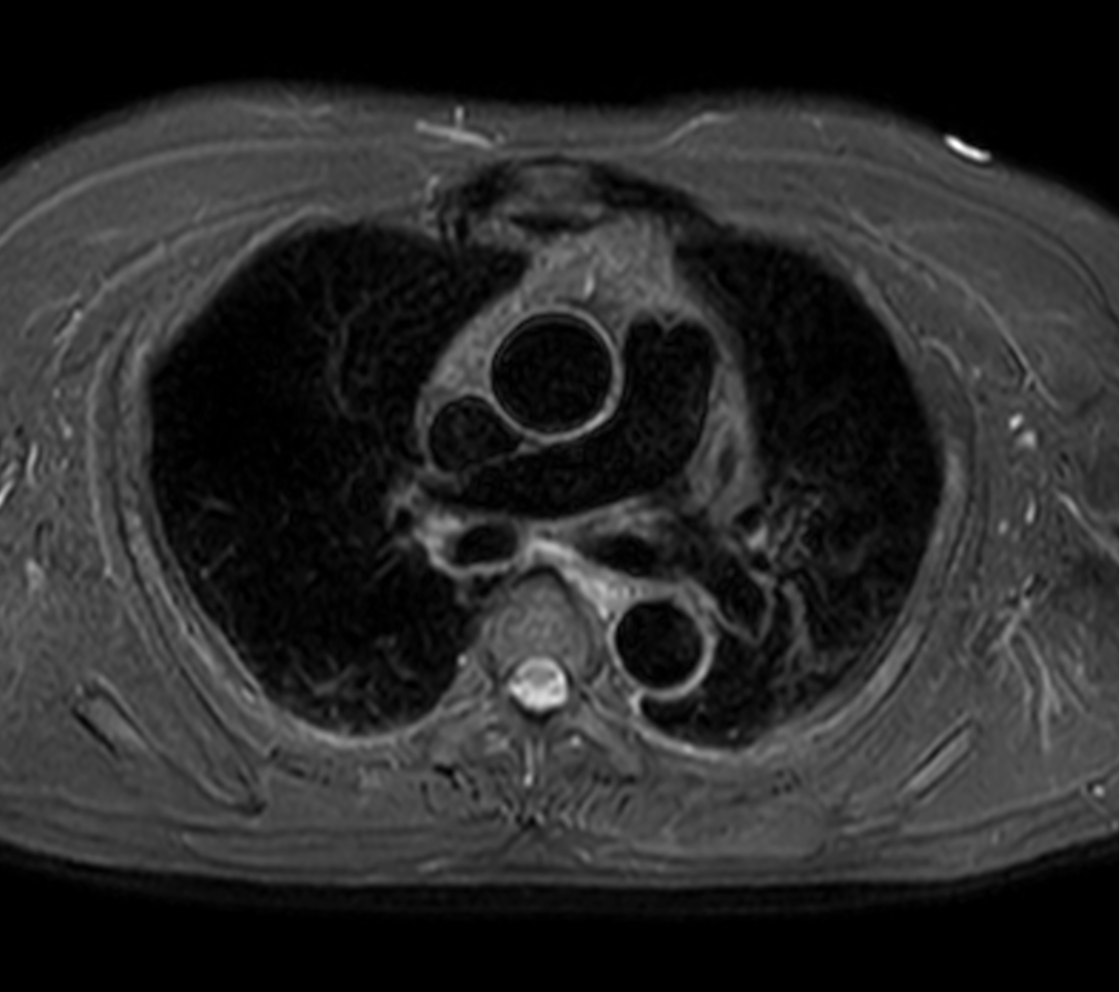Axial T2w STIR - Black Blood